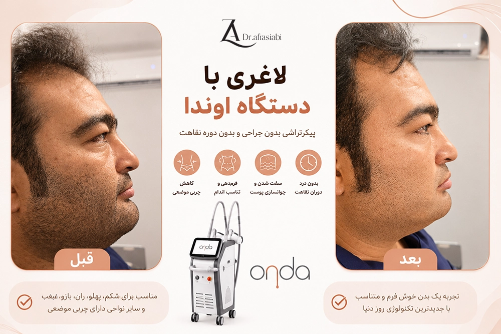 لاغری موضعی با دستگاه اوندا Onda | لاغری با دستگاه اوندا