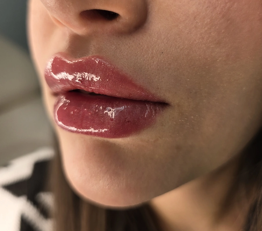 نمونه کار تزریق فیلر لب