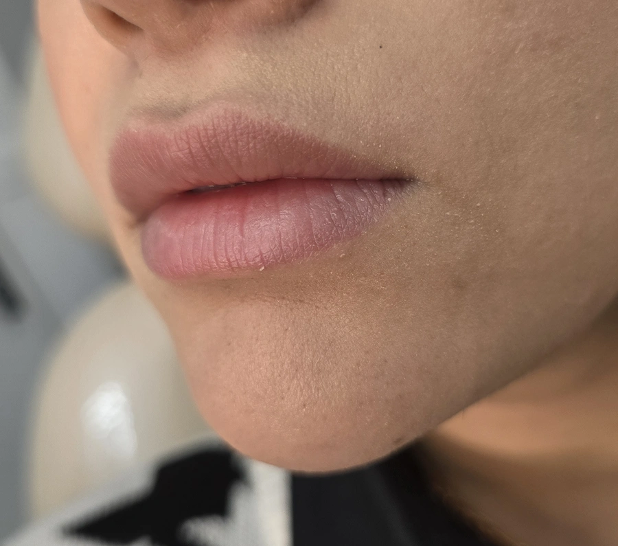 نمونه کار تزریق فیلر لب