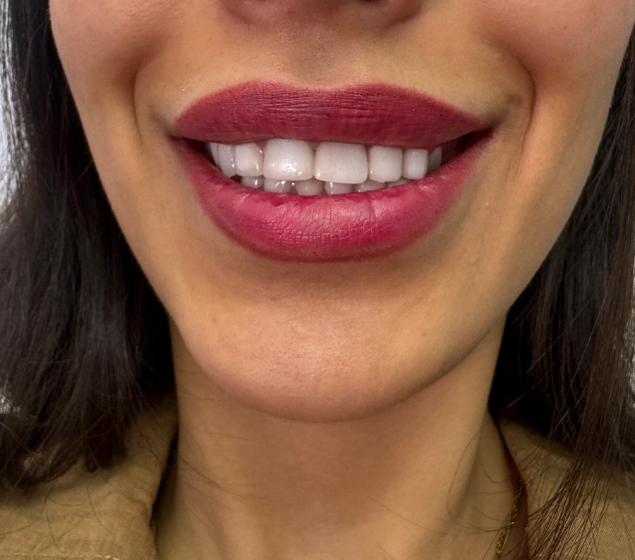 نمونه کار تزریق بوتاکس لبخند لثه‌ای